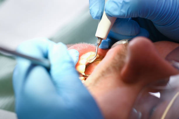 Best Emergency Wisdom Tooth Extraction in Buckley, WA